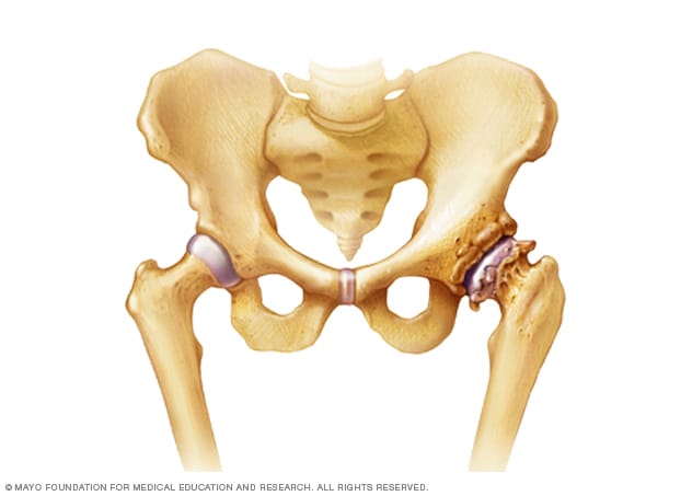 osteoarthritis-of-the-hip-mayo-clinic